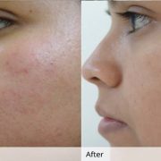 before-and-after-results-olive-oil-skin-acne-180×180-1.jpg